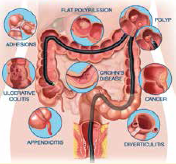What is the faecal calprotectin test?